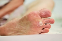Facts About Plantar Warts